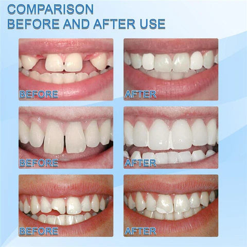 FALSE MOLDABLE™ - SONRISA PERFECTA